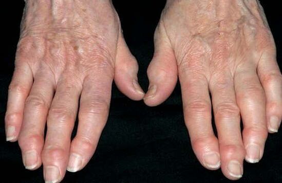 Arthrosis of the hands
