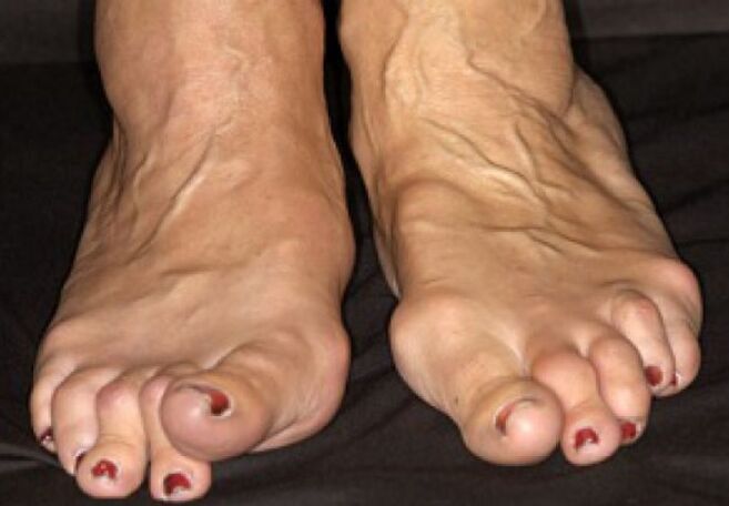 Completion of osteoarthritis