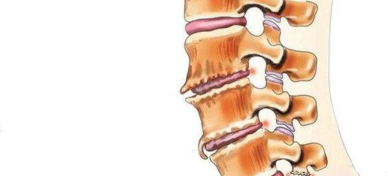 What is spondylose