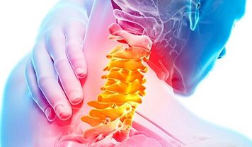 Signs of an osteochondrosis of the cervical spine