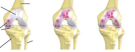 Degree of arthrosis
