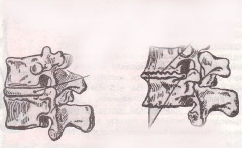The intervertebral disc is healthy and with lumbar osteochondrosis