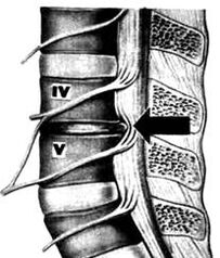 X -Ray image of the lumbar department of osteochondrosis