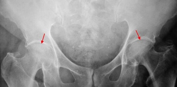 Double-sided CoksartRose image of the common gap, sclerosis of the articular surfaces