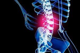 Osteochondrosis of the lumbar spine