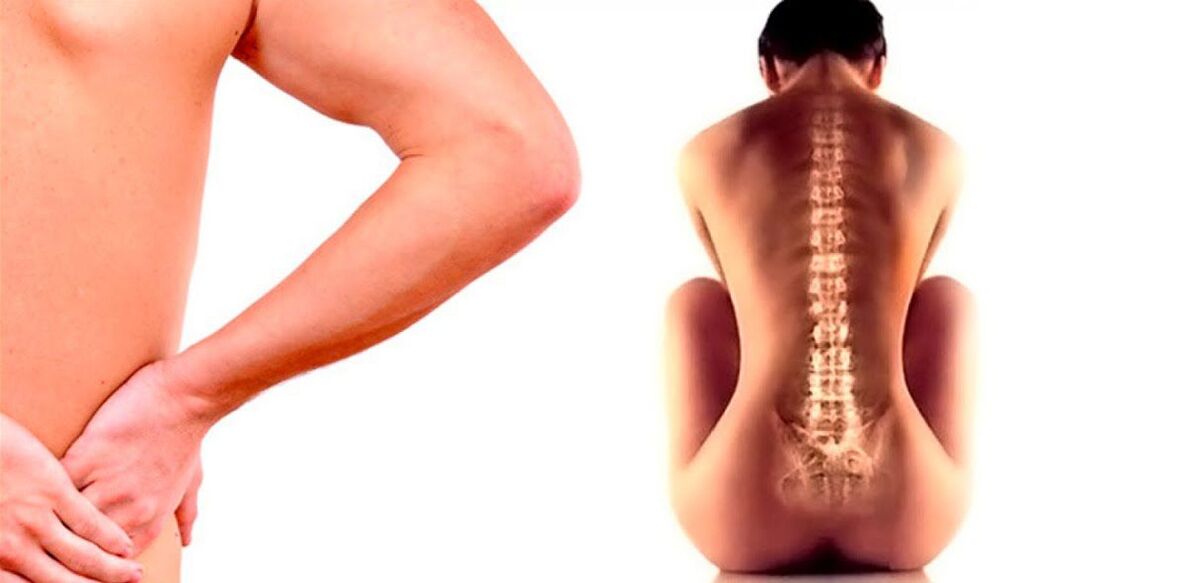 Lower back pain due to osteochondrosis